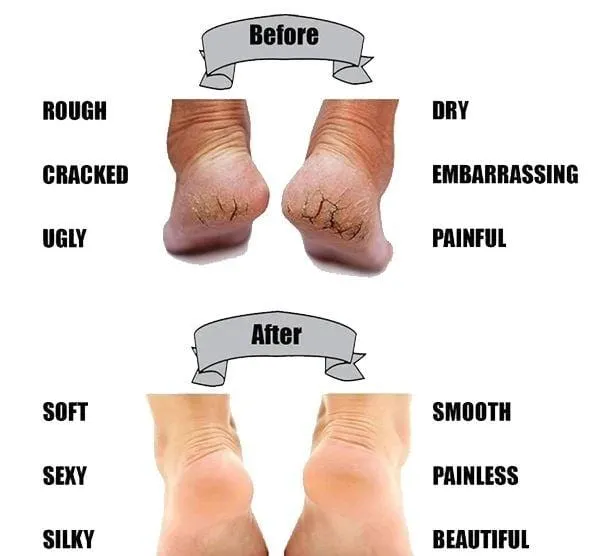 Heel Anti-Crack Sets